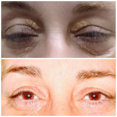 Eliminaci�n de Xantelasma